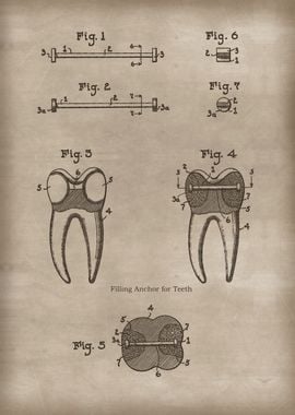 Filling Anchor for Teeth