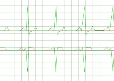 Normal Heart Rhythm Normal Heart Rhythm electrocardiogr ... 