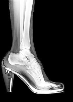 X Ray of a foot and ankle 