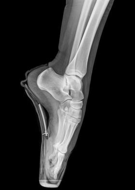 x ray of a ballet dancer