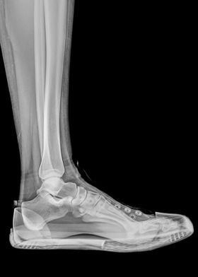 X Ray of a foot and ankle