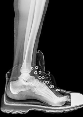 X Ray of a foot and ankle