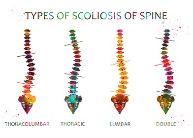 Type of scoliosis of spine