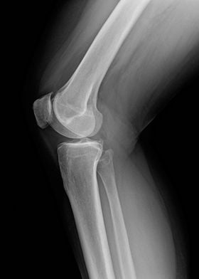 Xray of knees