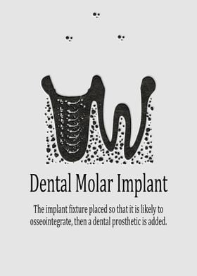 Dental Molar Implant