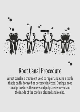 Root Canal Procedure