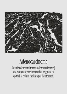 Adenocarcinoma