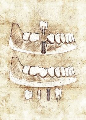 Dental implant procedure