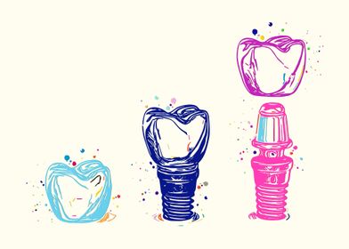 Dental Implant Art