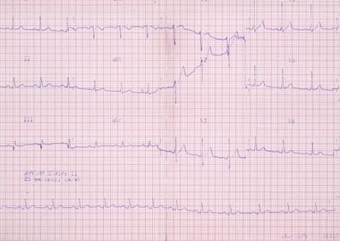 ECG real chart